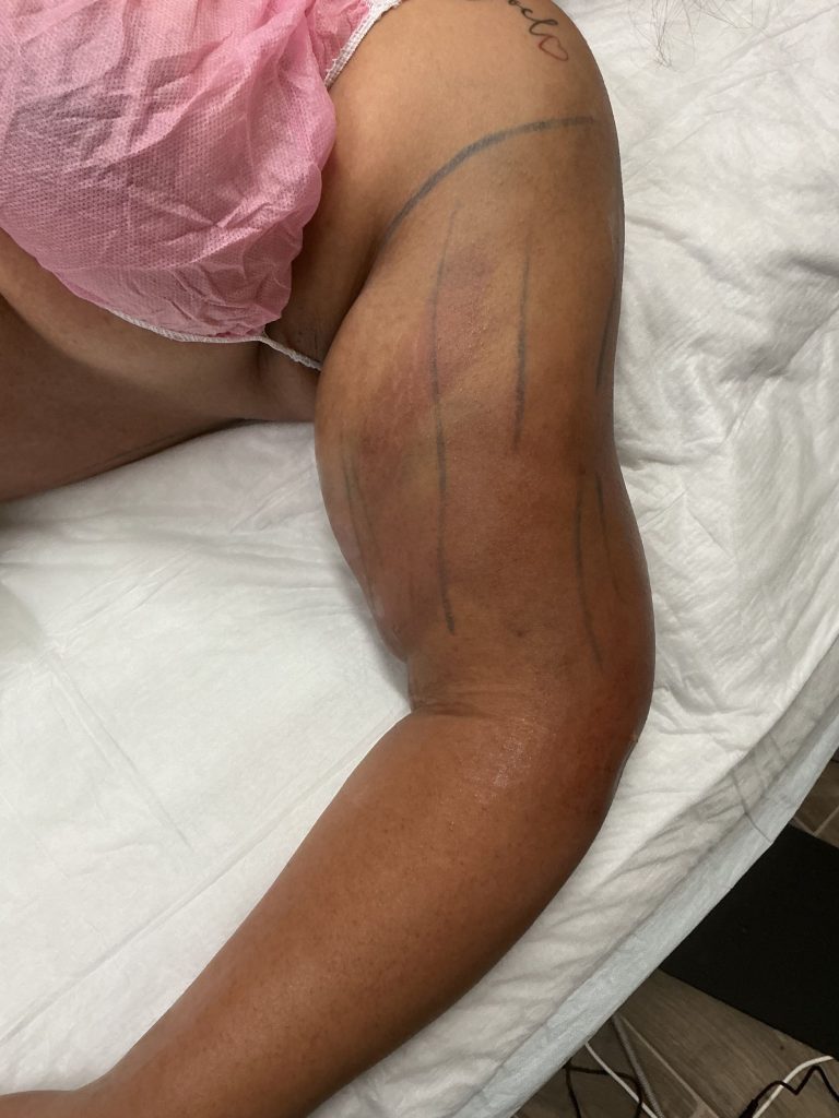 Supporting Lymphedema Recovery Through Compassionate Care - Client Testimonial 45